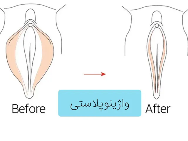 تجربه عمل واژینوپلاستی در شهریار-دکتر قرا محمدی-2303