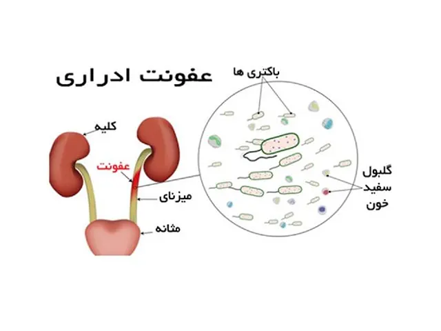 درمان سریع عفونت ادراری در شهریار-دکتر قرا محمدی-2897