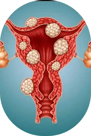 درمان فیبروم رحم در شهریار